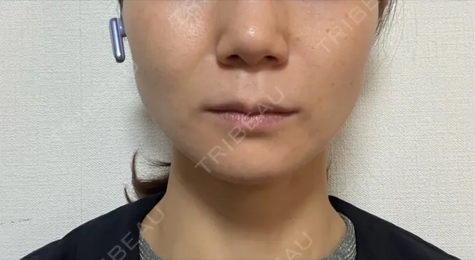 ボトックス（エラ・小顔） / ボトックス（肩） / ボトックス（眉間） / ボトックス（目尻） / ボトックス（額） / ボトックス（首） / ボトックス（人中） / ボトックス（バニーライン） DMTC CLINIC 日本橋院 DAY 8 メイン用