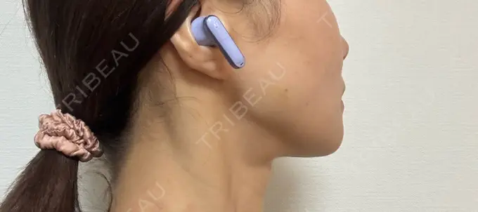 ボトックス（エラ・小顔） / ボトックス（肩） / ボトックス（眉間） / ボトックス（目尻） / ボトックス（額） / ボトックス（首） / ボトックス（人中） / ボトックス（バニーライン） DMTC CLINIC 日本橋院 DAY 8 メイン用