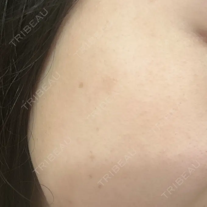 ピーリング（ハリ・ツヤ） / ルメッカ BITO BEAUTY CLINIC AFTER メイン用