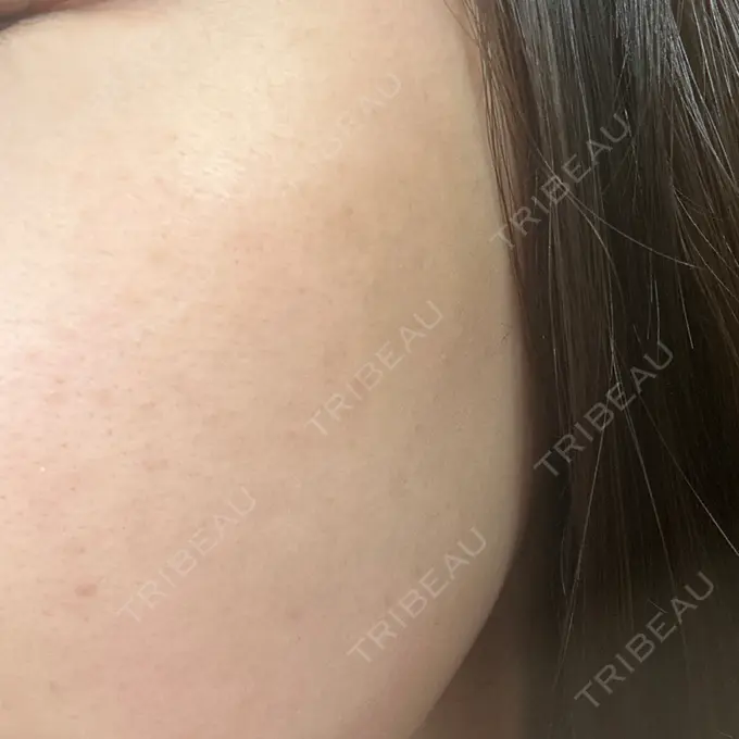 ピーリング（ハリ・ツヤ） / ルメッカ BITO BEAUTY CLINIC DAY 14 メイン用