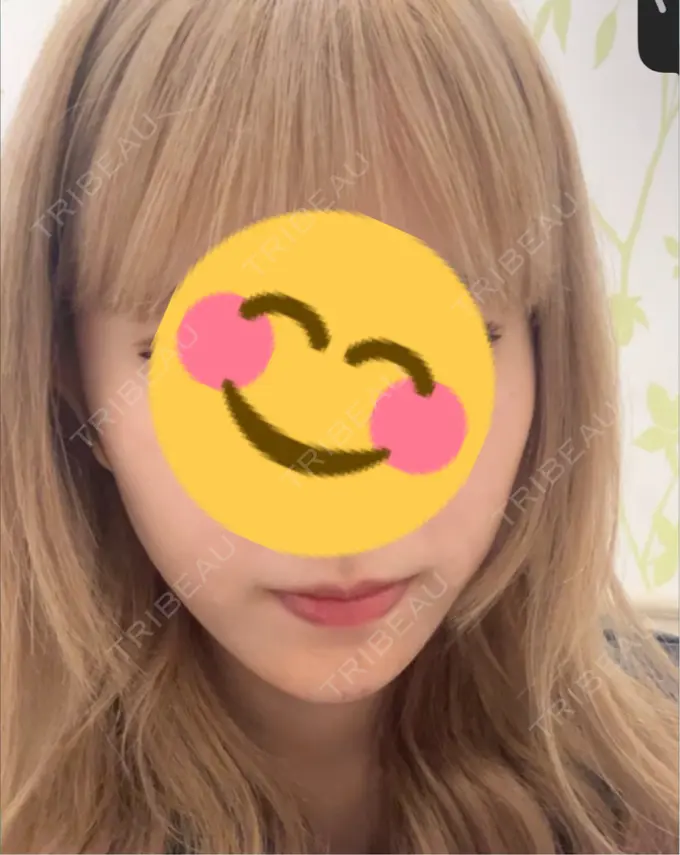 ヒアルロン酸注入（あご） 日比谷セントラルクリニック AFTER メイン用