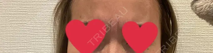 ボトックス（あご） / ボトックス（口角） / ボトックス（眉間） / ボトックス（目尻） / ボトックス（額） / ボトックス（人中） / ボトックス（ガミースマイル） DMTC CLINIC 渋谷院 DAY 2 メイン用