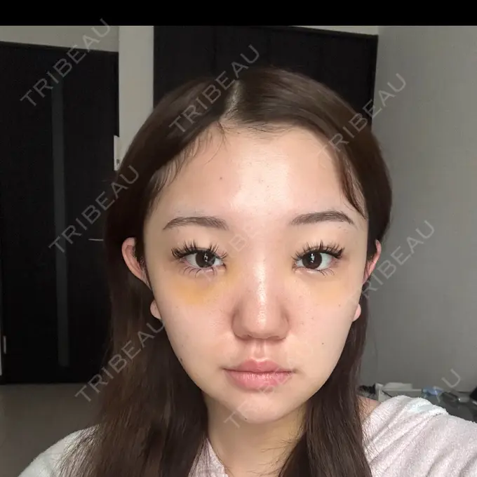 クマ治療 / 脂肪吸引（顔） / ヒアルロン酸注入（涙袋） / ヒアルロン酸注入（目の下） ネビュラクリニック 東京錦糸町院 DAY 5 メイン用