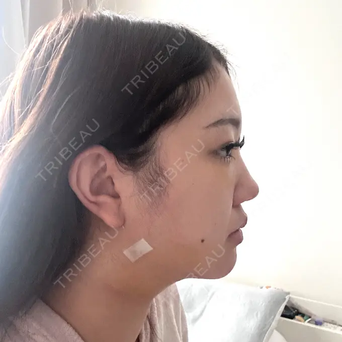 クマ治療 / 脂肪吸引（顔） / ヒアルロン酸注入（涙袋） / ヒアルロン酸注入（目の下） ネビュラクリニック 東京錦糸町院 DAY 5 メイン用