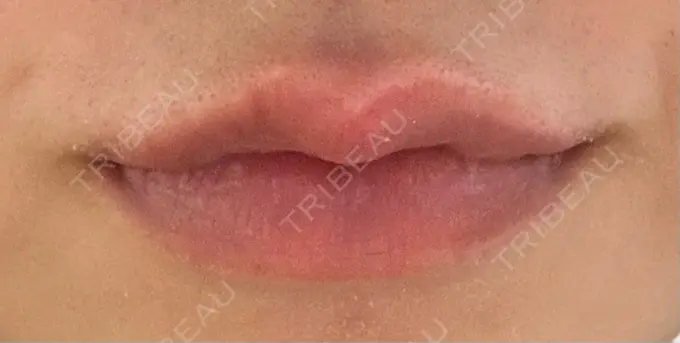 ヒアルロン酸注入（唇） 目白ホワイトクリニック DAY 3 メイン用