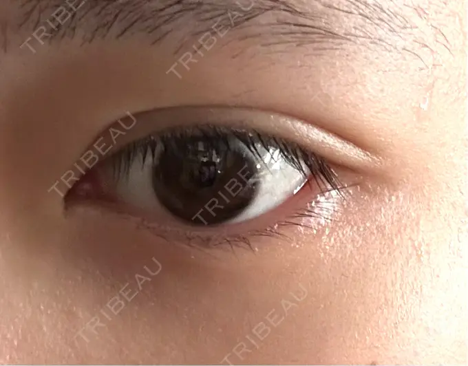 二重埋没 恵聖会クリニック 心斎橋院 DAY 31 メイン用