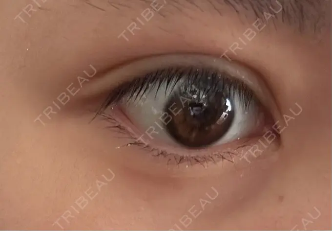 二重埋没 恵聖会クリニック 心斎橋院 DAY 31 メイン用