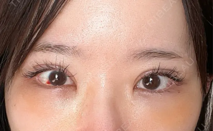 クマ治療 / 下まぶたの脂肪取り / 脂肪注入（目の下） ルラ美容クリニック 渋谷本院 DAY 5 メイン用