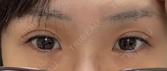 二重埋没 アリエル美容クリニック 横浜院 DAY 21 メイン用