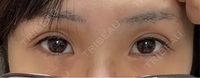 二重埋没 アリエル美容クリニック 横浜院 DAY 21 メイン用