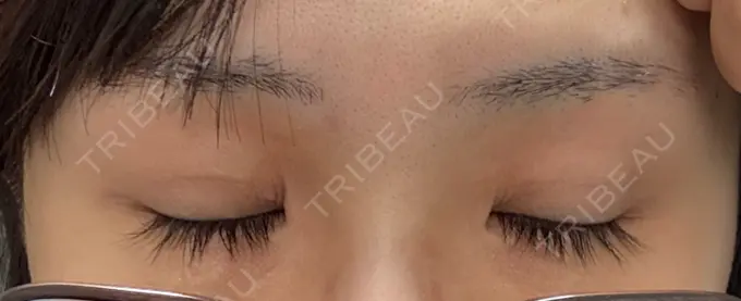 二重埋没 アリエル美容クリニック 横浜院 DAY 21 メイン用