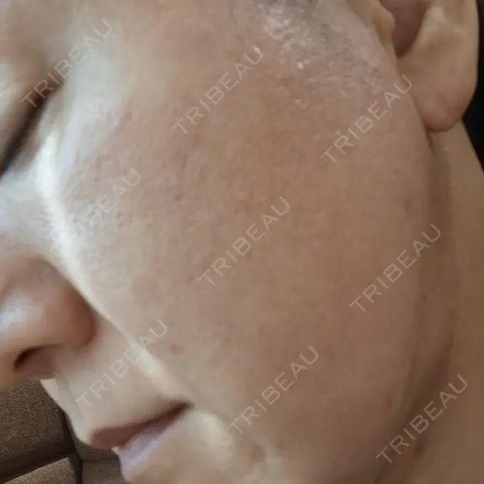 ボトックス（額） / ピコスポット 東京ココセランクリニック DAY 9 メイン用