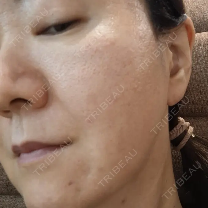 ボトックス（額） / ピコスポット 東京ココセランクリニック DAY 9 メイン用