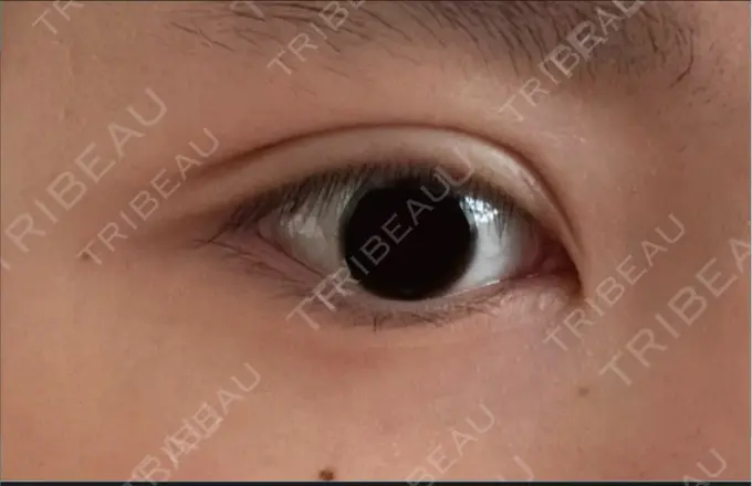 二重埋没 恵聖会クリニック 心斎橋院 DAY 27 メイン用