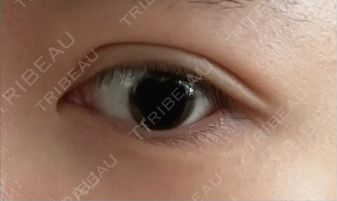 二重埋没 恵聖会クリニック 心斎橋院 DAY 27 メイン用