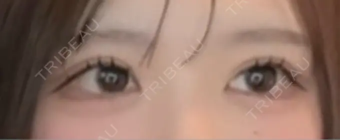 二重埋没 恵聖会クリニック 心斎橋院 AFTER メイン用