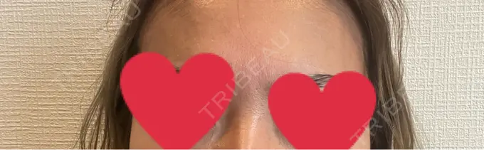 ボトックス（あご） / ボトックス（口角） / ボトックス（眉間） / ボトックス（目尻） / ボトックス（額） / ボトックス（人中） / ボトックス（ガミースマイル） DMTC CLINIC 渋谷院 DAY 3 メイン用