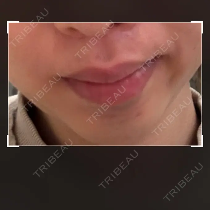 医療脱毛（顔） 日本美容・医療クリニック 六本木院 DAY 1 メイン用