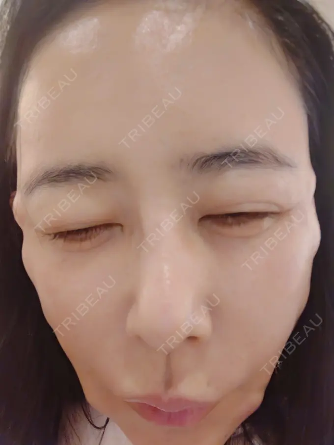 ジャルプロ Natural Skin Clinic 自由ヶ丘院 DAY 0 メイン用