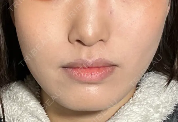 糸リフト / ヒアルロン酸注入（頬） 東京シンデレラ美容外科 池袋院 AFTER メイン用