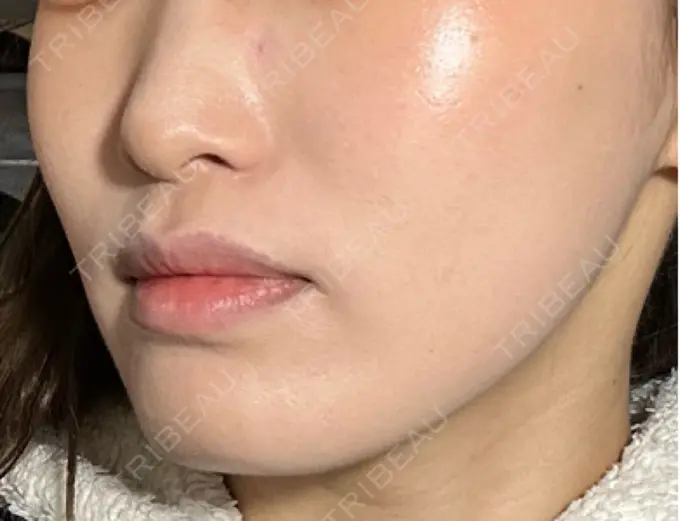 糸リフト / ヒアルロン酸注入（頬） 東京シンデレラ美容外科 池袋院 DAY 10 メイン用