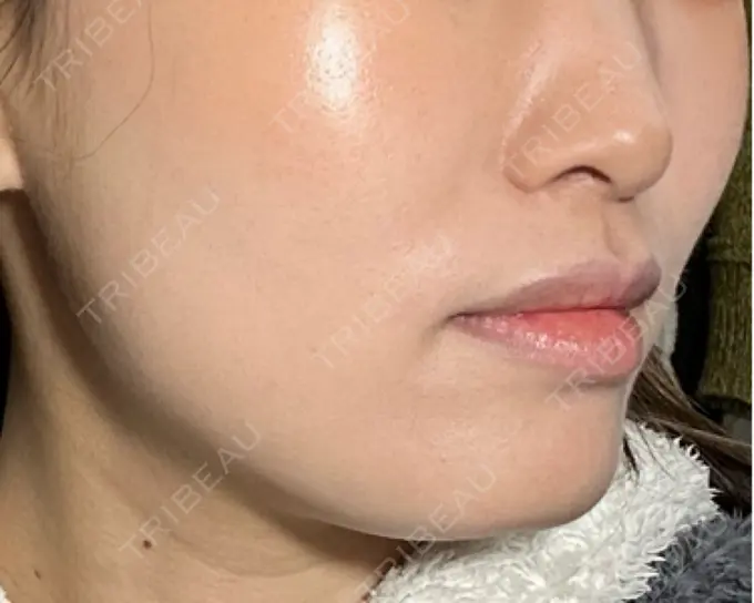 糸リフト / ヒアルロン酸注入（頬） 東京シンデレラ美容外科 池袋院 DAY 10 メイン用