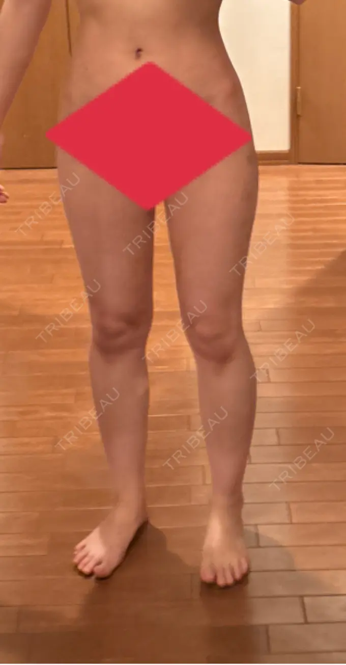 脂肪吸引（脚） / 豊胸（脂肪注入） 湘南美容クリニック Regno 銀座院 DAY 35 メイン用