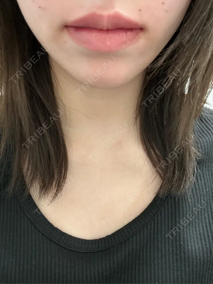 ヒアルロン酸注入（唇） 新未来クリニック AFTER メイン用