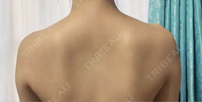 ボトックス（肩） / ワキ汗治療（ボトックス） DMTC CLINIC 渋谷院 DAY 5 メイン用