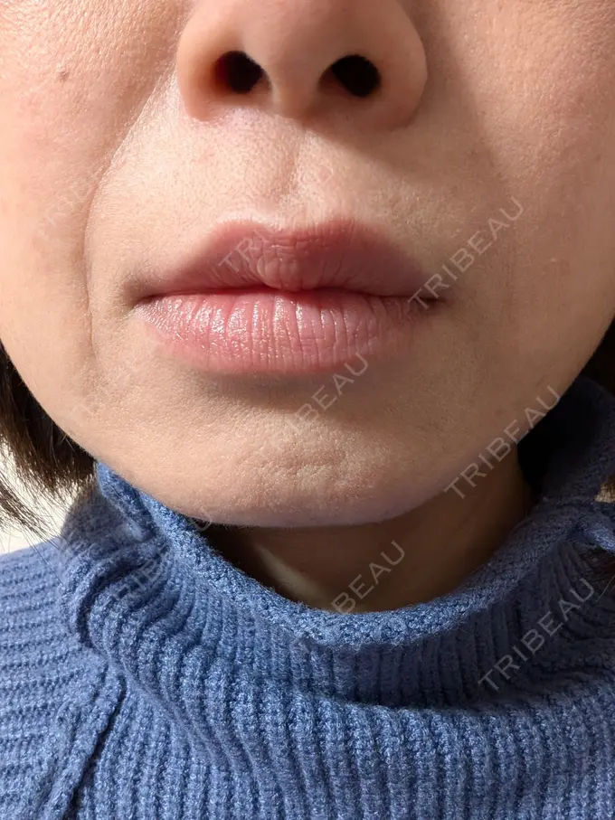 肌育注射（ジュベルックなど） ゆきスキンクリニック 東池袋 DAY 2 メイン用