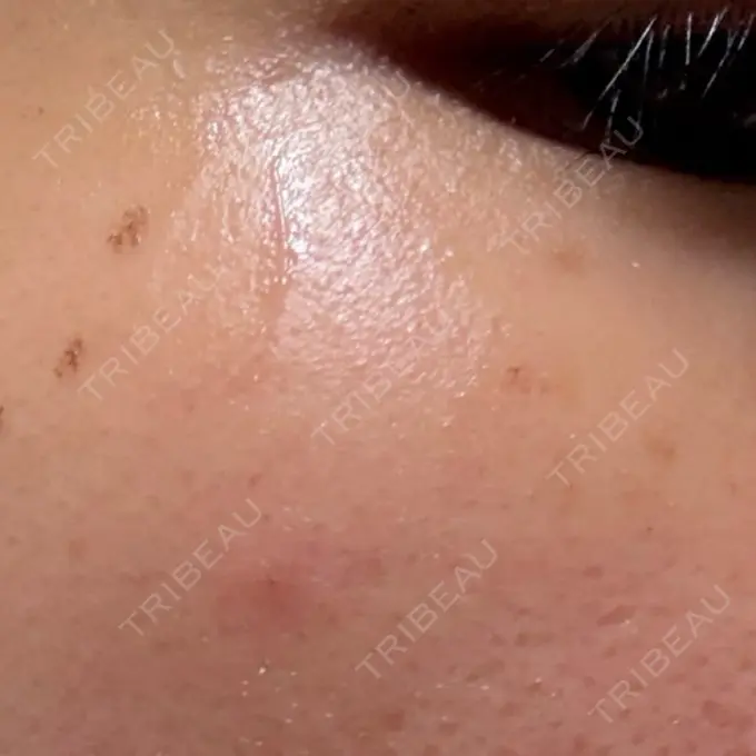 ルメッカ MIO CLINIC 梅田院 DAY 1 メイン用