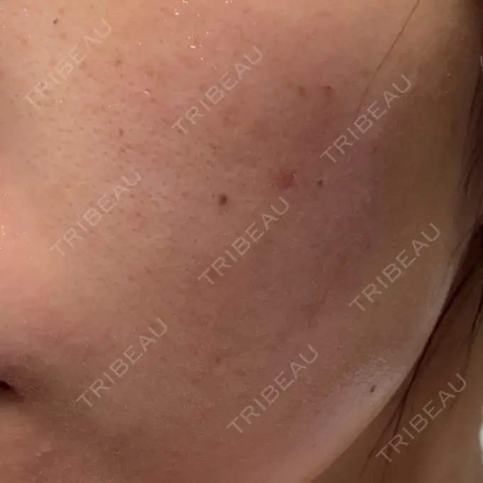 ルメッカ MIO CLINIC 梅田院 DAY 1 メイン用