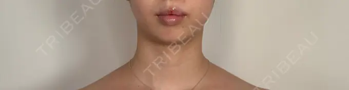 ヒアルロン酸注入（あご） / ヒアルロン酸注入（唇） アリエル美容クリニック 水戸院 DAY 0 メイン用