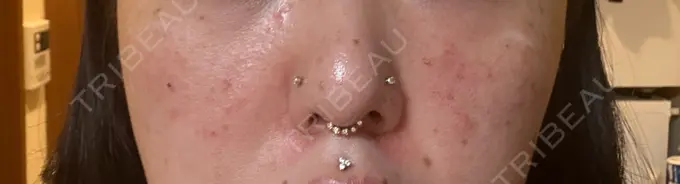 マイクロボトックス Natural Skin Clinic 自由ヶ丘院 DAY 0 メイン用