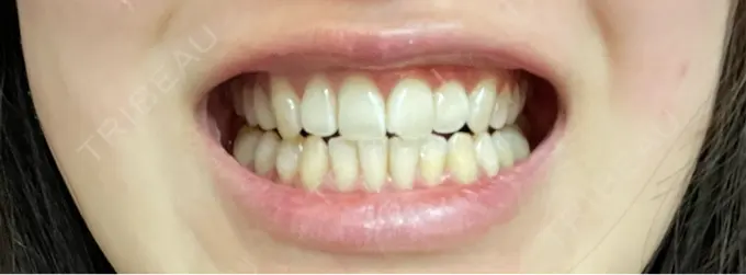 ホワイトニング 銀座本院 歯と美容のクリニック AFTER メイン用