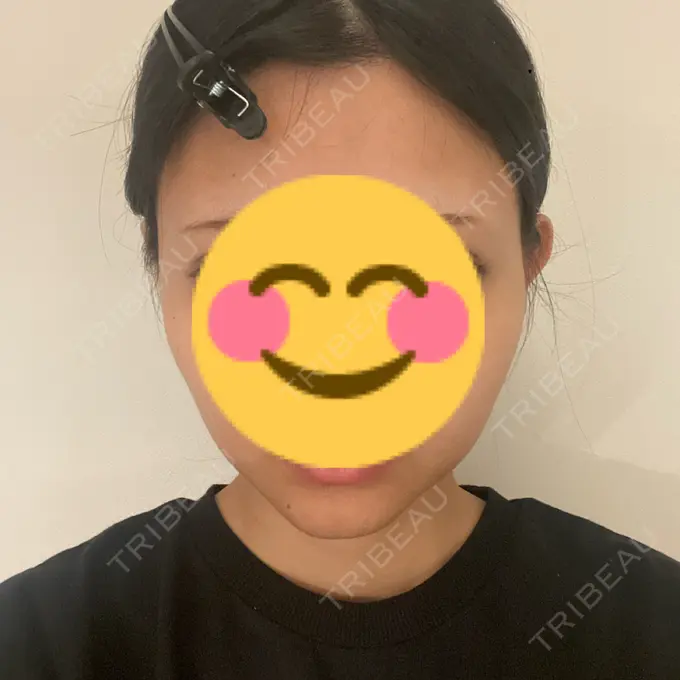 ボトックス（エラ・小顔） 東京美容外科 秋田院 AFTER メイン用