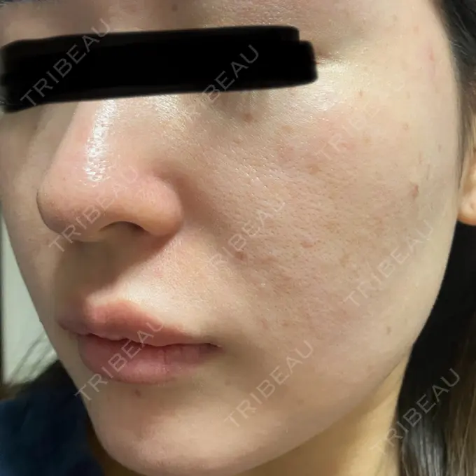 ボトックス（眉間） / ボトックス（額） / エレクトロポレーション / 光治療（フォトフェイシャルなど） / ルメッカ BITO BEAUTY CLINIC DAY 0 メイン用