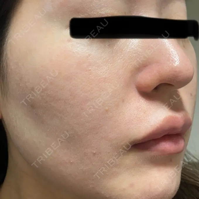 ボトックス（眉間） / ボトックス（額） / エレクトロポレーション / 光治療（フォトフェイシャルなど） / ルメッカ BITO BEAUTY CLINIC DAY 0 メイン用