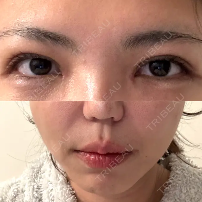 二重埋没 / 目頭切開 / 糸リフト / 鼻翼基部形成（貴族手術） / ヒアルロン酸注入（鼻翼基部） 東京シンデレラ美容外科 池袋院 AFTER メイン用
