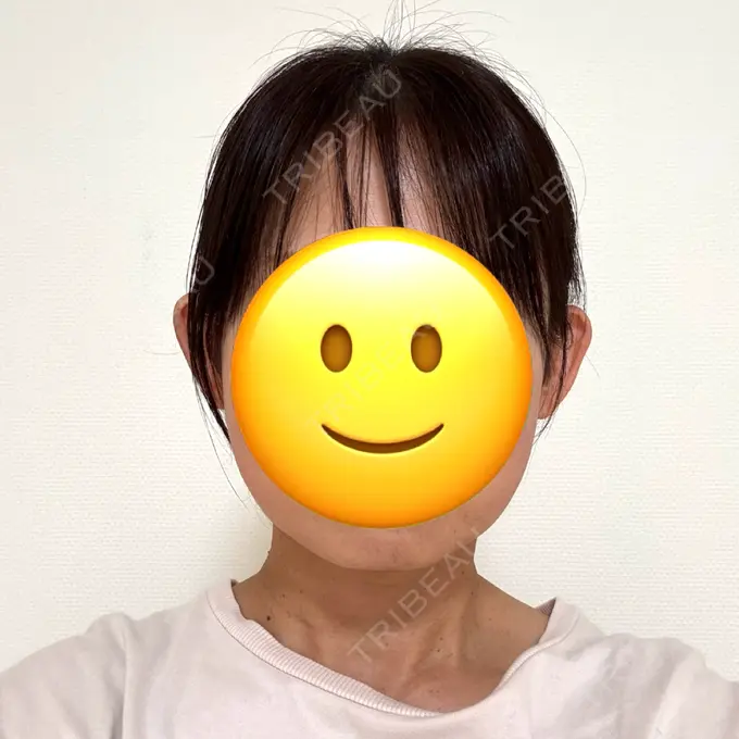 ボトックス（エラ・小顔） 共立美容外科 神戸三宮院 AFTER メイン用