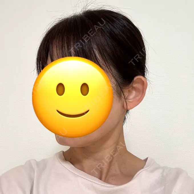 ボトックス（エラ・小顔） 共立美容外科 神戸三宮院 DAY 1 メイン用