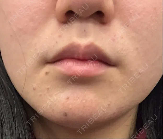 インモード 東京シルククリニック 東京神田院 AFTER メイン用