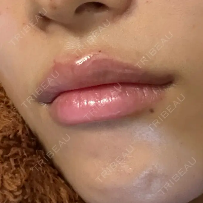 ヒアルロン酸注入（涙袋） / ヒアルロン酸注入（鼻） / ヒアルロン酸注入（唇） / ヒアルロン酸注入（頬） HAAB×DREAM BEAUTY CLINIC 大阪梅田院 DAY 1 メイン用