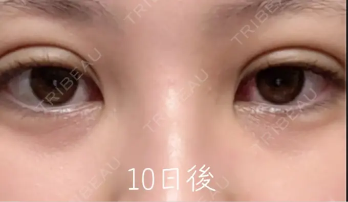 自然癒着法 eクリニック 福岡院 DAY 10 メイン用