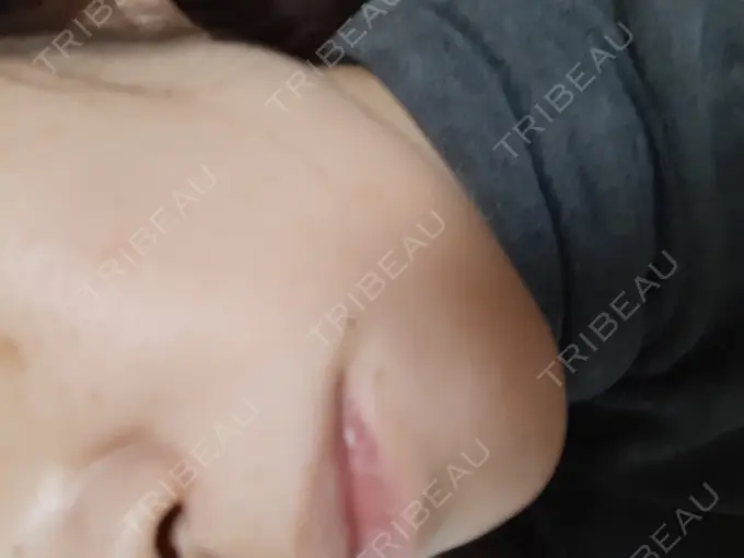 ハイフ（顔） ミニマムスキンクリニック池袋 DAY 3 メイン用