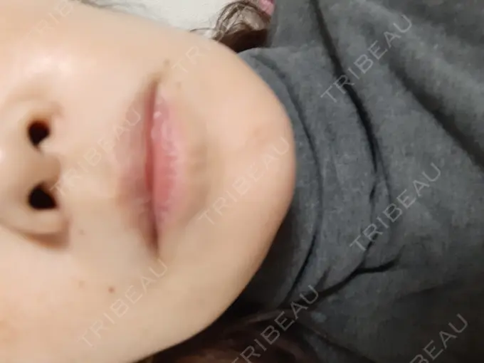 ハイフ（顔） ミニマムスキンクリニック池袋 AFTER メイン用