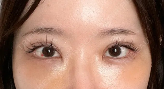 クマ治療 / 下まぶたの脂肪取り / 脂肪注入（目の下） ルラ美容クリニック 渋谷本院 DAY 6 メイン用