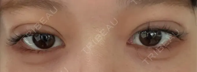 二重埋没 恵聖会クリニック 京橋院 DAY 5 メイン用