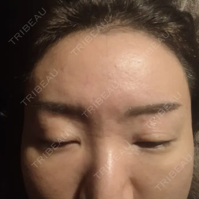 ボトックス（額） / ピコスポット 東京ココセランクリニック AFTER メイン用