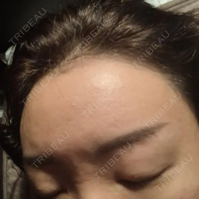 ボトックス（額） / ピコスポット 東京ココセランクリニック DAY 10 メイン用